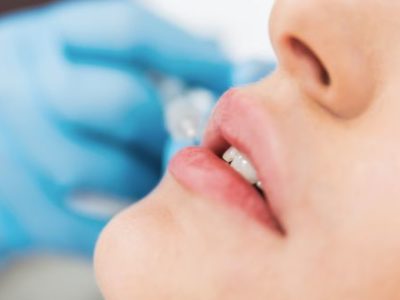 Top Tips on Having Lip Fillers in Thailand
