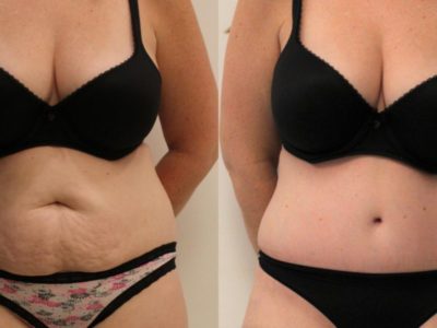 Top 8 reasons to have Tummy Tuck Surgery in Turkey