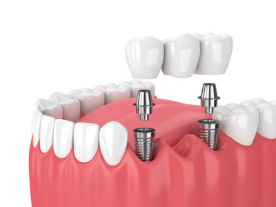 Top Facts on Having Dental Implants in Thailand