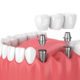 Top Facts on Having Dental Implants in Thailand