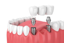Top Facts on Having Dental Implants in Turkey
