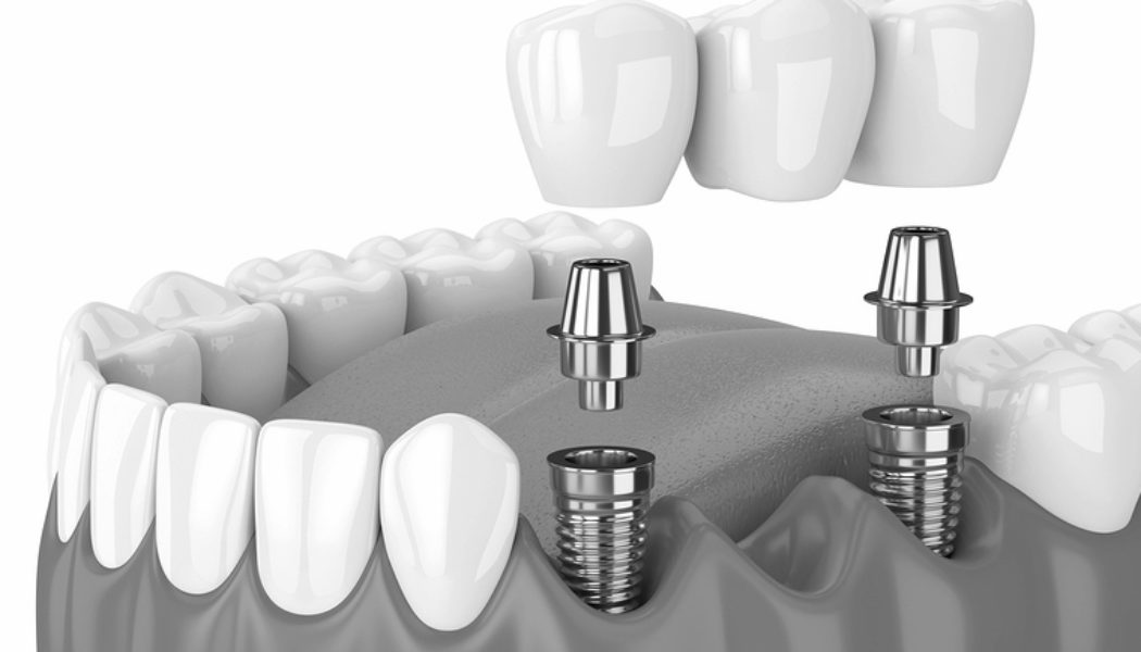 Top Tips to Improve Your Smile With an All-on-2 Dental Implants in Bangkok