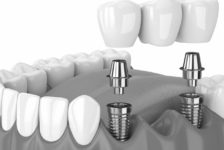 Top Tips to Improve Your Smile With an All-on-2 Dental Implants in Bangkok