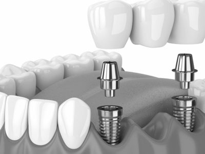 Top Tips to Improve Your Smile With an All-on-2 Dental Implants in Bangkok