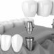 Top Tips to Improve Your Smile With an All-on-2 Dental Implants in Bangkok