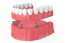 Top Tips to Improve Your Smile With an All-on-4 Dental Implants in Bangkok