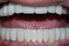 Top Tips to Improve Your Smile With an All-on-8 Dental Implants in Bangkok