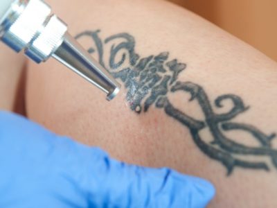 Top Cities for Laser Tattoo Removal