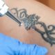 Top Cities for Laser Tattoo Removal