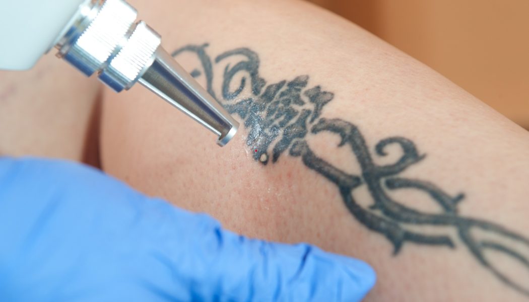Top Cities for Laser Tattoo Removal