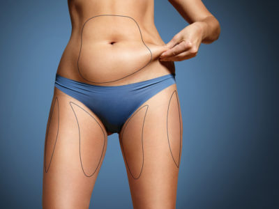 What can Liposuction do for my Appearance?