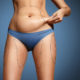 What can Liposuction do for my Appearance?