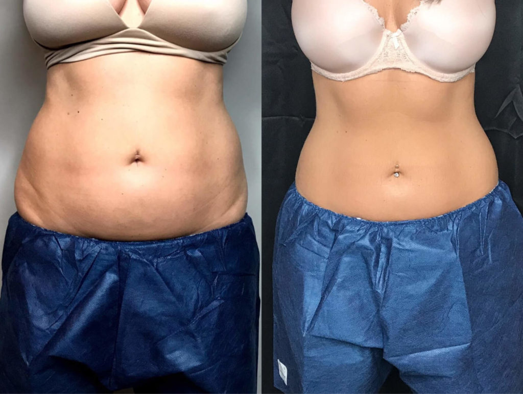 Is Coolsculpting a Good Alternative to Liposuction?