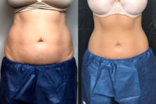 Is Coolsculpting a Good Alternative to Liposuction?
