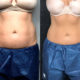Is Coolsculpting a Good Alternative to Liposuction?