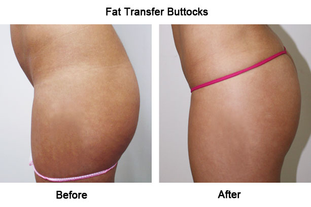 Is Fat Transfer a Liposuction Procedure? - MyMediTravel Knowledge