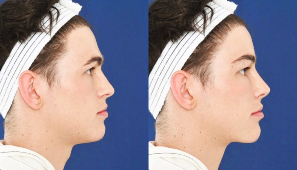 Top Facts on Having a Facial Feminization Surgery (FFS) in Turkey