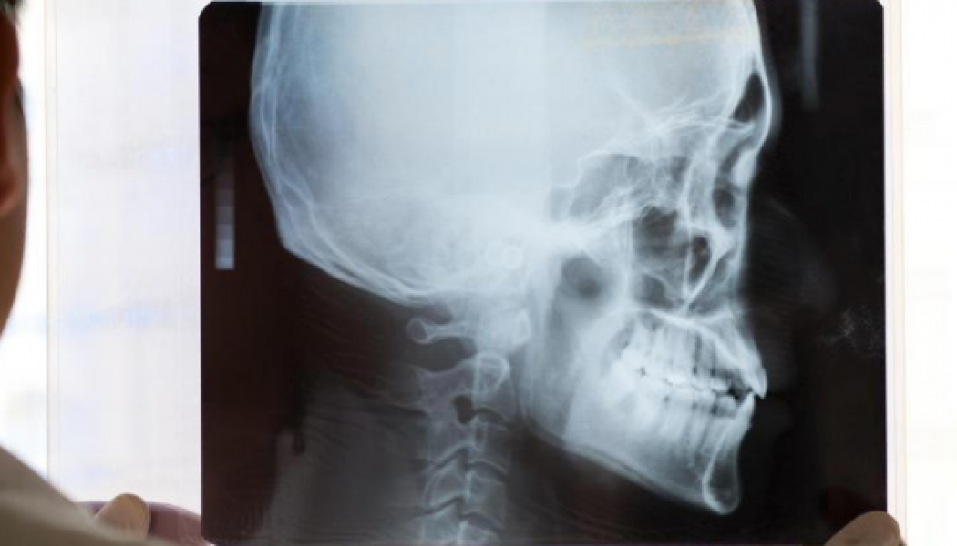 Cranioplasty Procedure Description