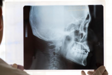 Cranioplasty Procedure Description
