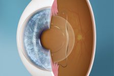 Implantable Contact Lens (ICL) Procedure Description