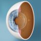 Implantable Contact Lens (ICL) Procedure Description