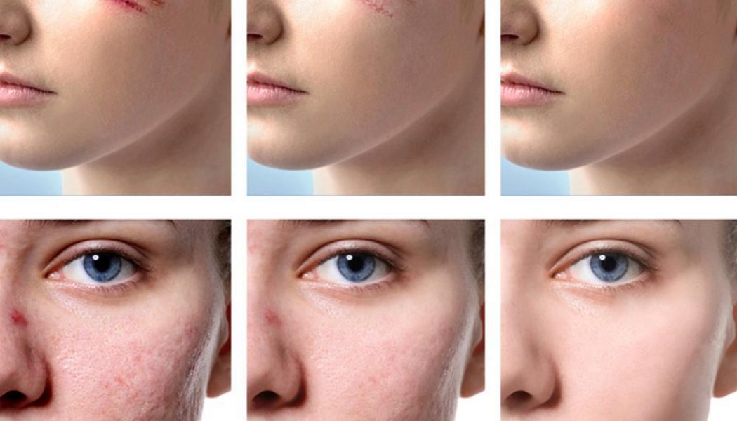Scar Removal Procedure Description