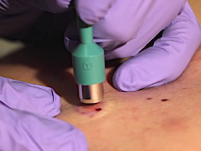 Skin Biopsy Procedure Description