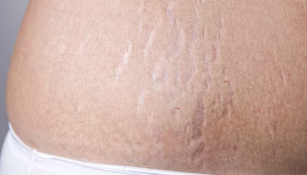 Stretch Marks Removal Procedure Description