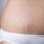 Stretch Marks Removal Procedure Description