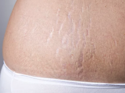 Stretch Marks Removal Procedure Description