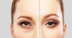 Lower-Eyelid Blepharoplasty.Upper blepharoplasty.Correcting the aging process