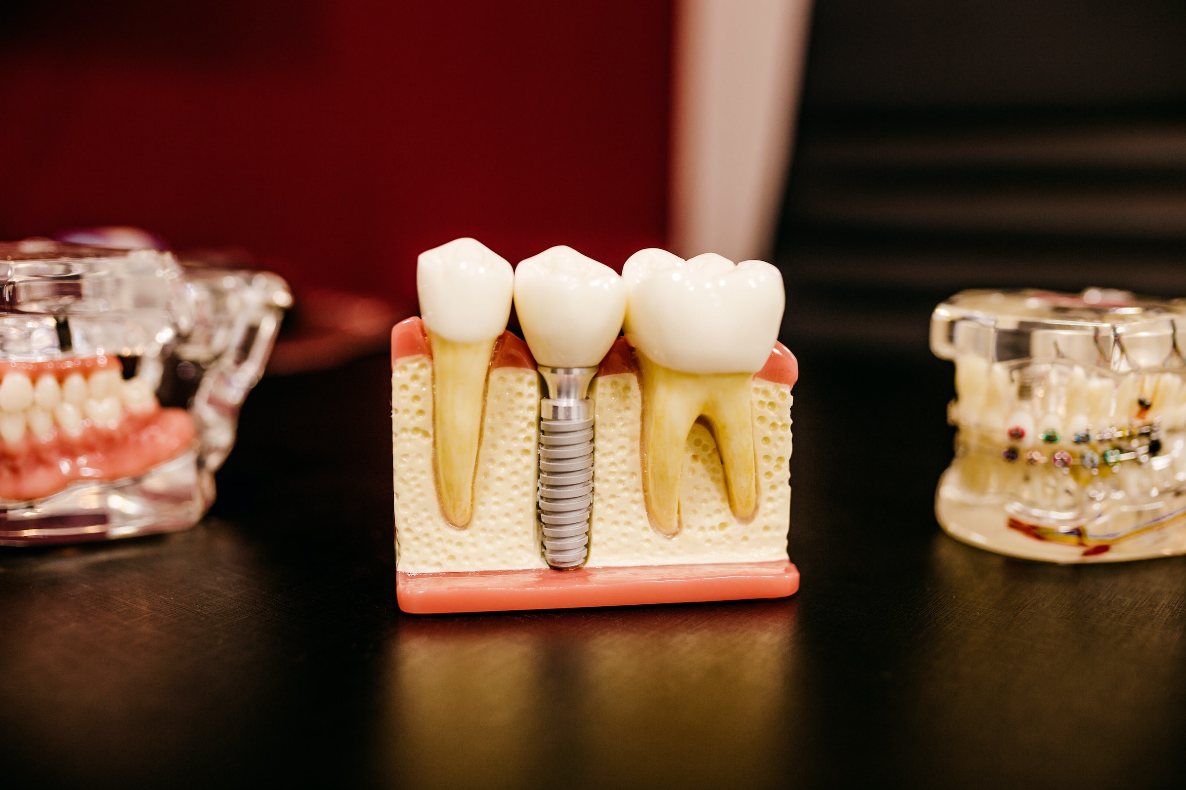Dental Implants Cost Explained: A Comprehensive Guide
