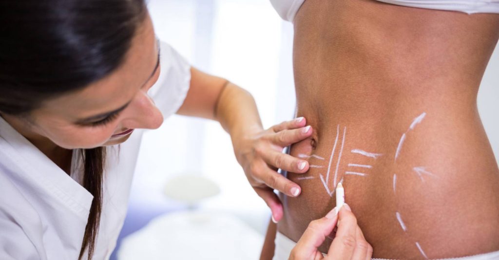 What They Don’t Tell You About Liposuction