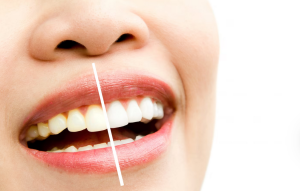 Whitening teeth