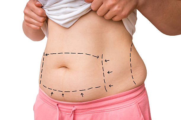 Tummy Tucks: Exploring the Surge in Demand for Abdominoplasty