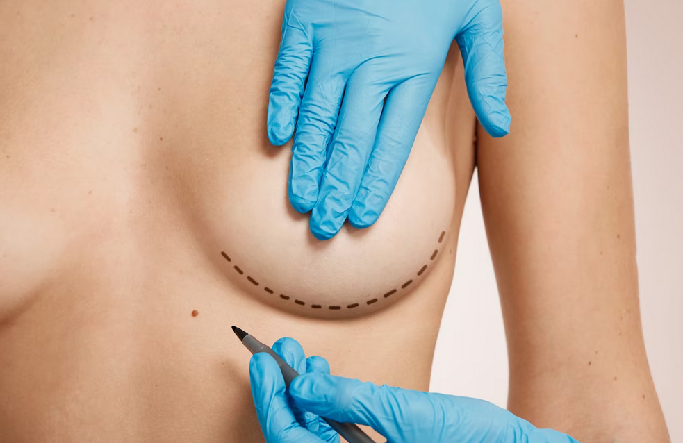 Top Questions to ask before your Breast Augmentation Consultation