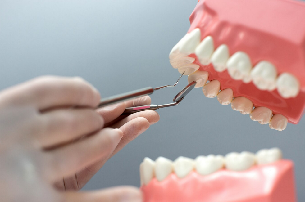 Exploring the Emerging Popularity of Dental Implants in India