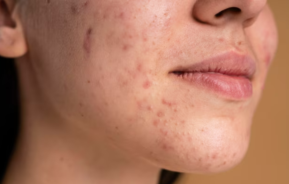 Breaking Down the Myths: What Really Causes Acne and How to Treat It