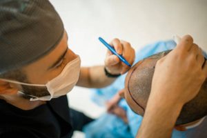 Hair transplant in Mexico
