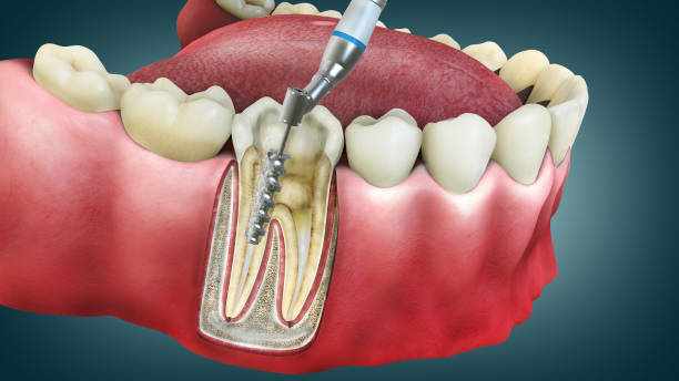 Facts About Root Canals Every Patient Should Know