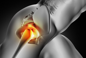Hip replacement