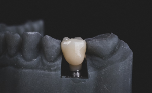 Dental implant 